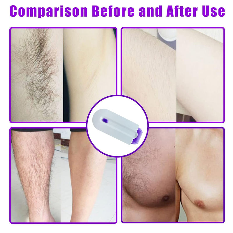 LaserEpilator - Laser Epilierer